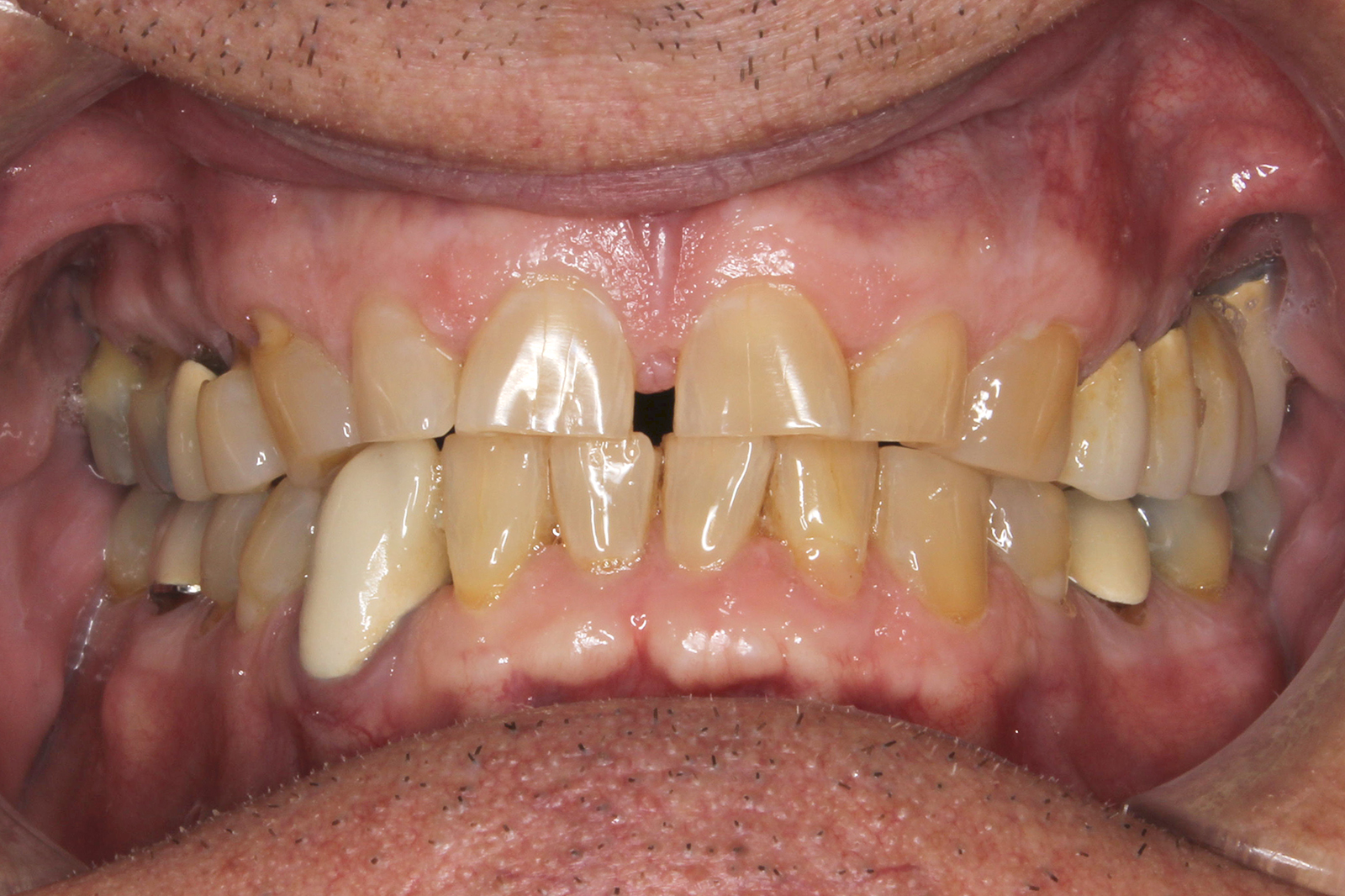 Anterior Anterior