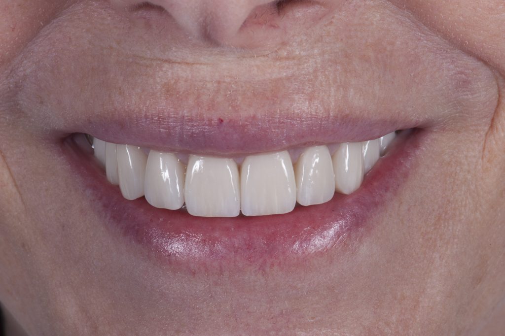 Crowns Vs. Porcelain Veneers Vs. Dental Implants and When to Use Which