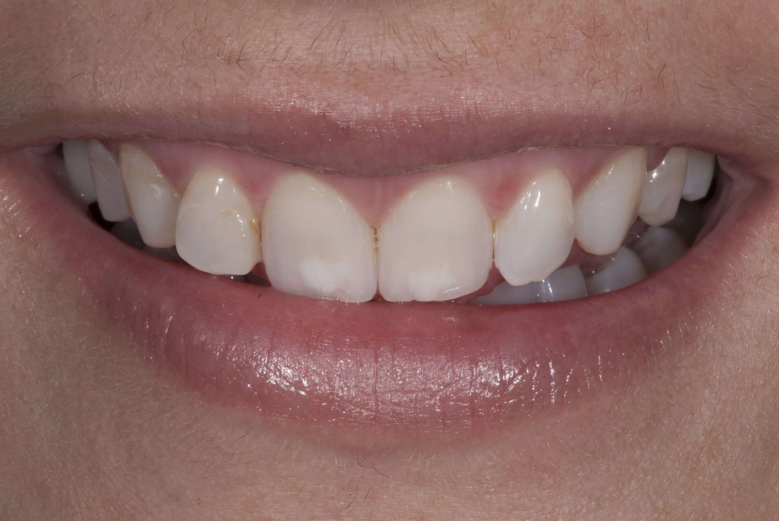Composite fillings and composite veneers TM