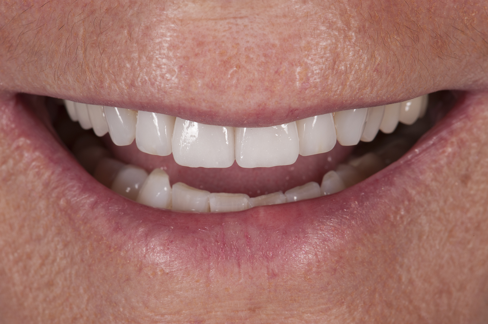 Porcelain Laminate Veneers TM