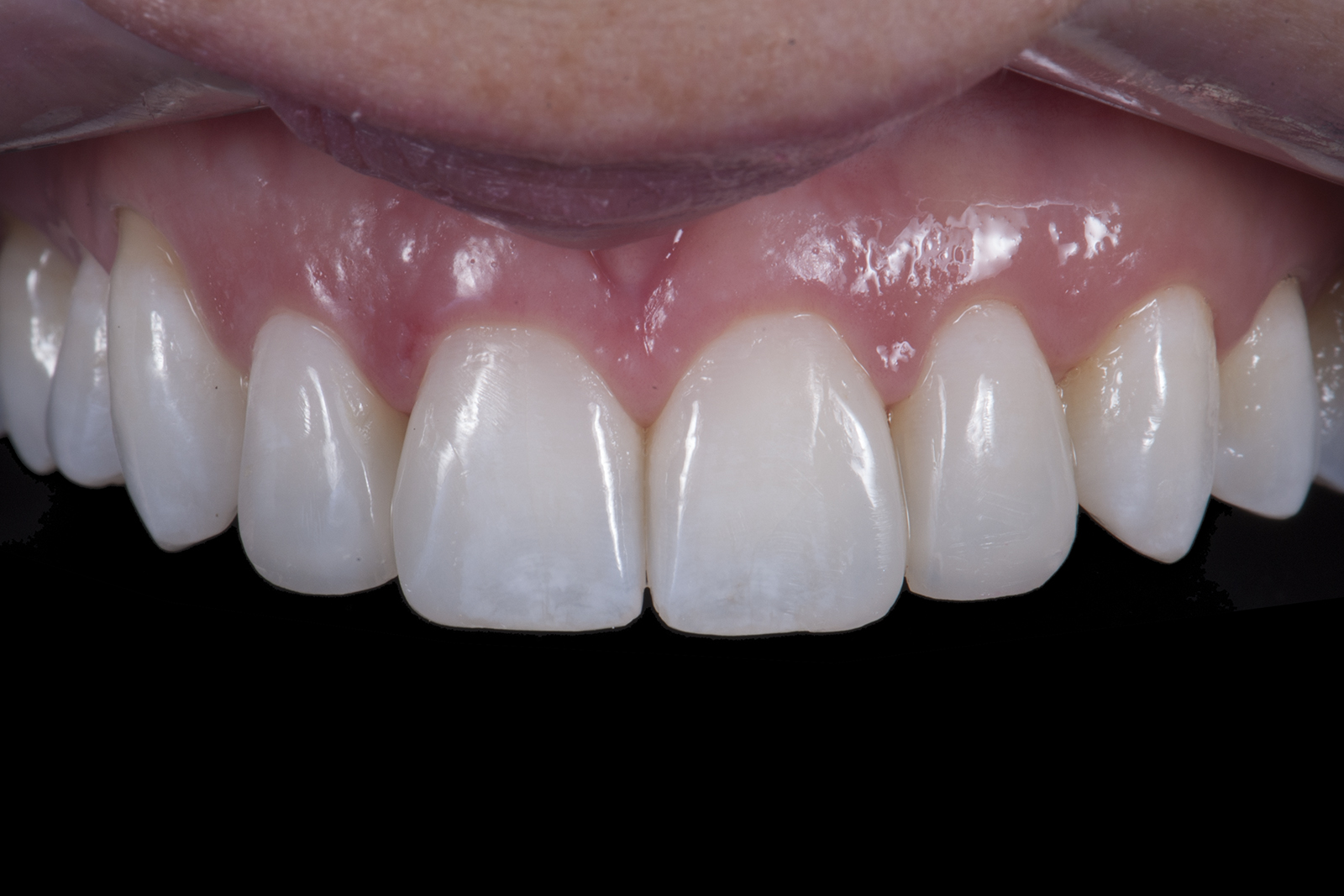 Composite fillings and composite veneers TM
