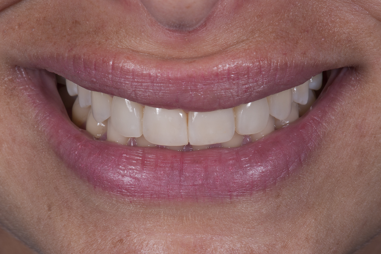 Composite fillings and composite veneers TM
