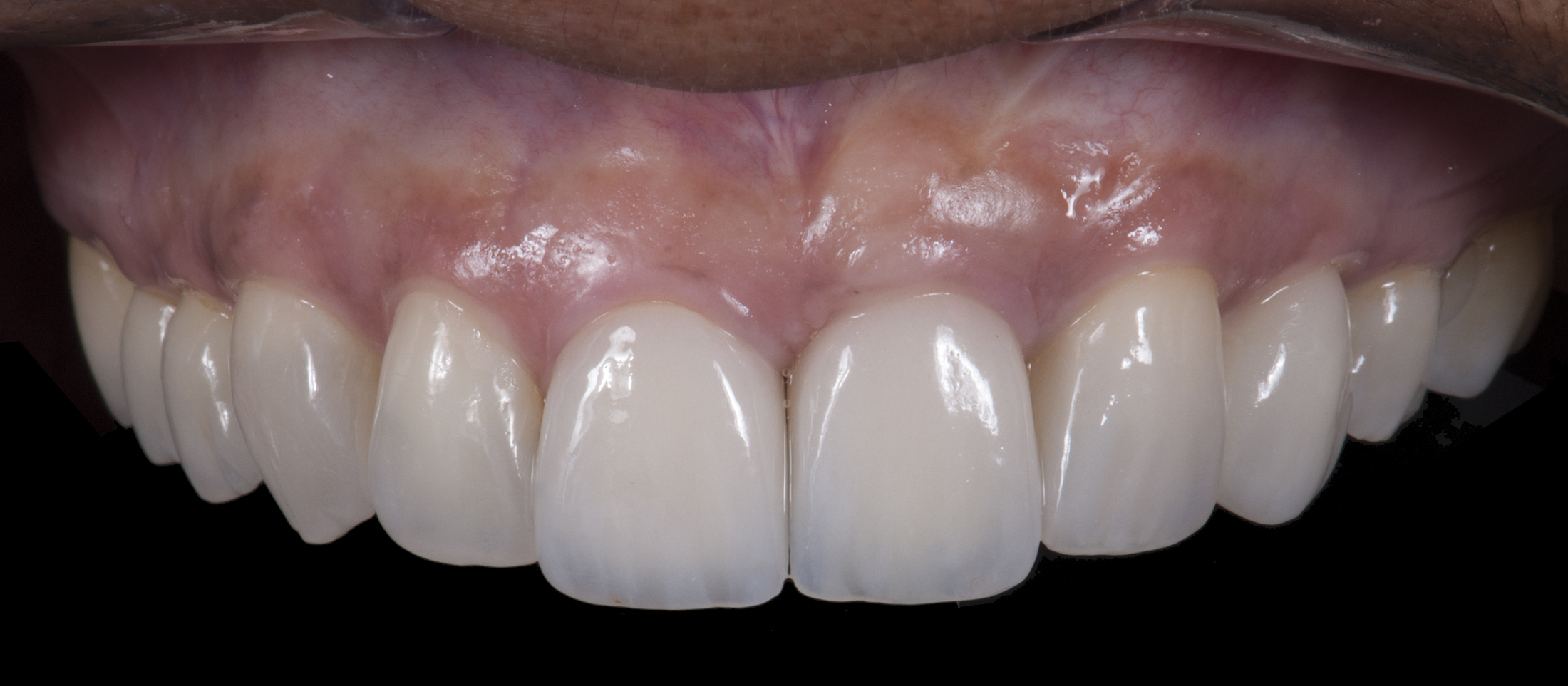 Porcelain Laminate Veneers TM