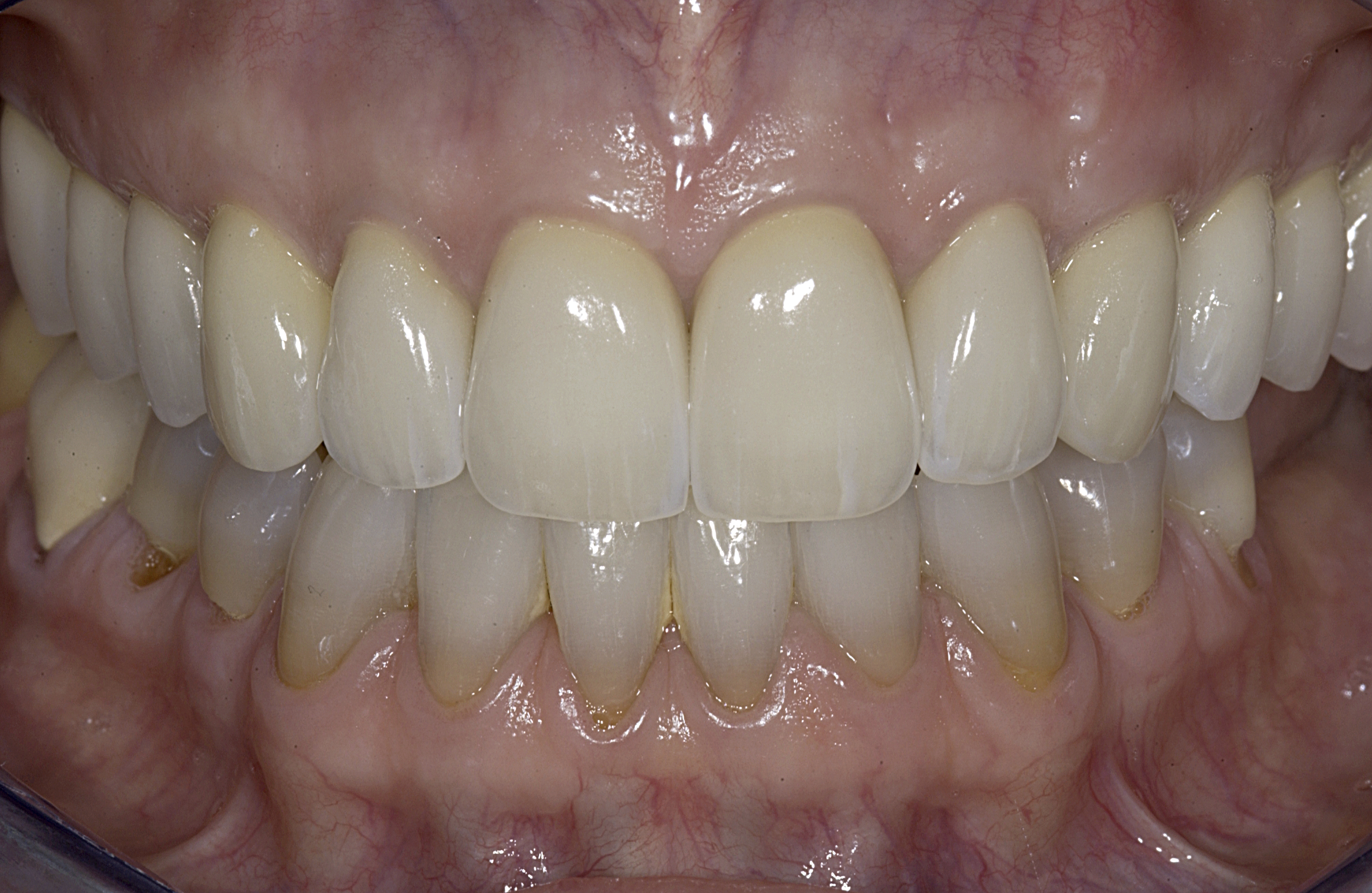 final intraoral frontal final intraoral frontal