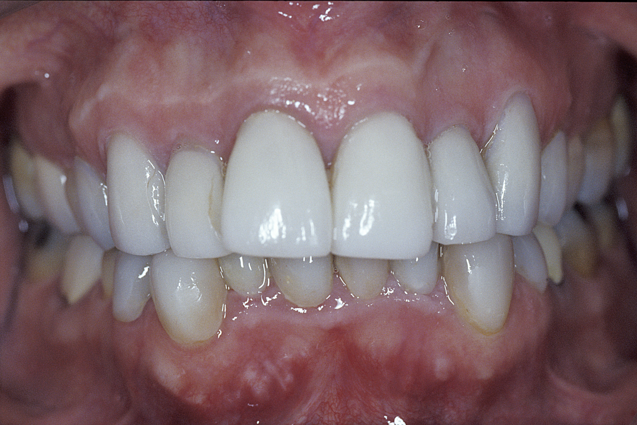 initial intraoral frontal 2 initial intraoral frontal 2