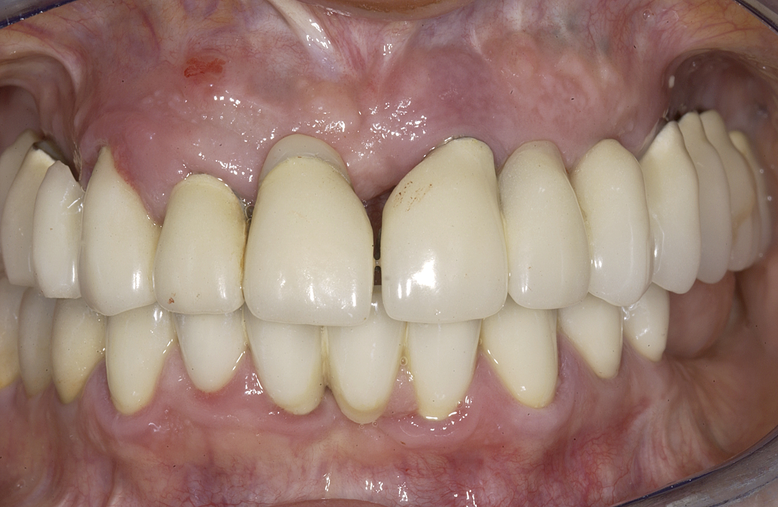 initial intraoral initial intraoral