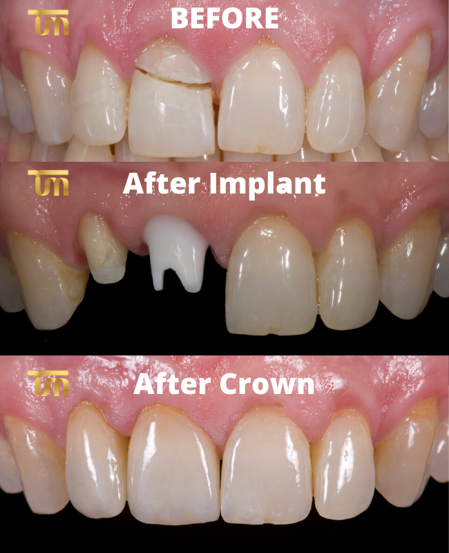 Crowns Vs. Porcelain Veneers Vs. Dental Implants and When to Use Which