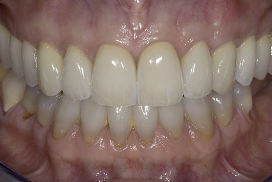 final intraoral frontal