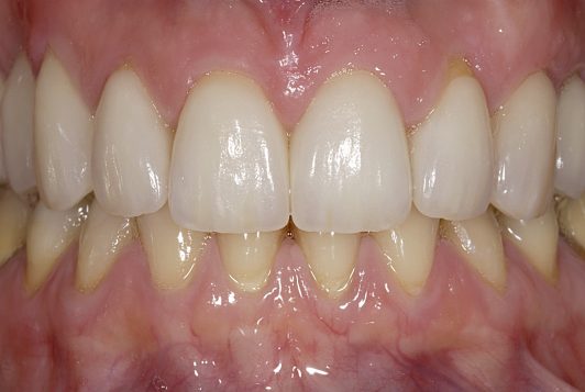 final intraoral frontal