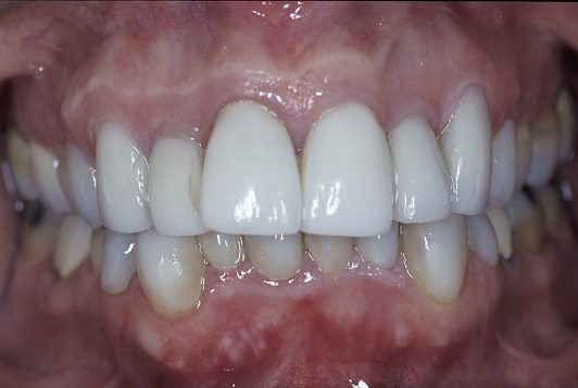initial intraoral frontal 2