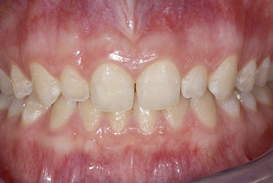 initial intraoral frontal before