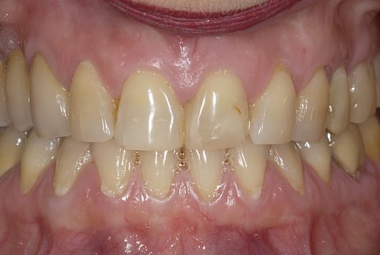initial intraoral frontal