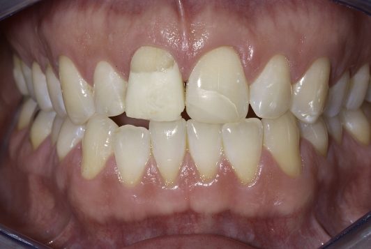 intraoral frontal