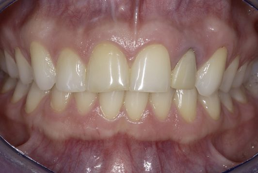 intraoral frontal 2