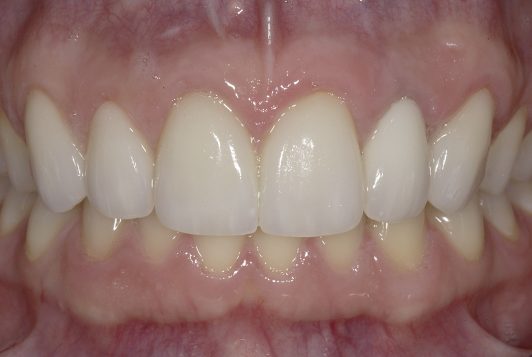 intraoral frontal